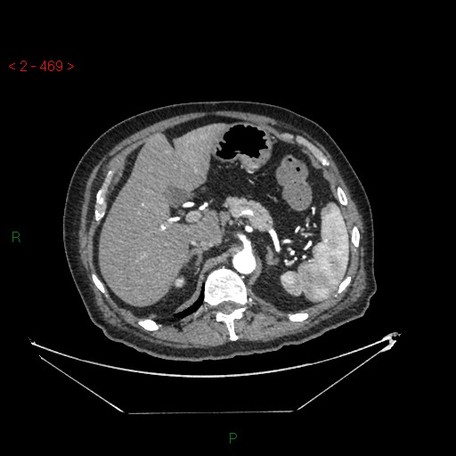 Circumaortic left renal vein and doubled left renal arteries (Radiopaedia 52268-58158 A 5).jpg