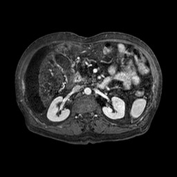 File:Cirrhosis and hepatocellular carcinoma in the setting of hemochromatosis (Radiopaedia 75394-86594 Axial T1 C+ fat sat 196).jpg