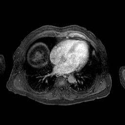Cirrhosis and hepatocellular carcinoma in the setting of hemochromatosis (Radiopaedia 75394-86594 Axial T1 C+ fat sat 341).jpg