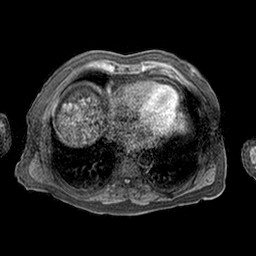 Cirrhosis and hepatocellular carcinoma in the setting of hemochromatosis (Radiopaedia 75394-86594 Axial T1 C+ fat sat 76).jpg