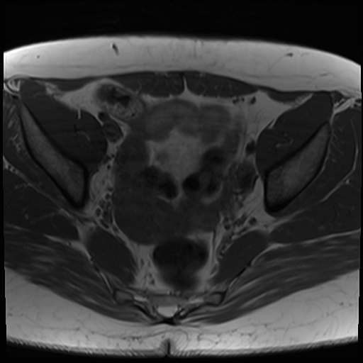 File:Class II Mullerian duct anomaly- unicornuate uterus with rudimentary horn and non-communicating cavity (Radiopaedia 39441-41755 Axial T1 14).jpg