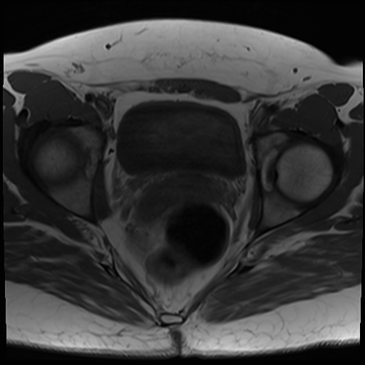 File:Class II Mullerian duct anomaly- unicornuate uterus with rudimentary horn and non-communicating cavity (Radiopaedia 39441-41755 Axial T1 20).jpg