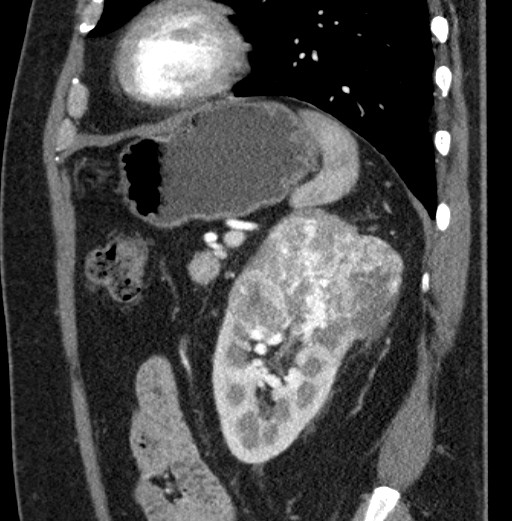 File:Clear cell renal cell carcinoma (Radiopaedia 61449-69393 D 23).jpg