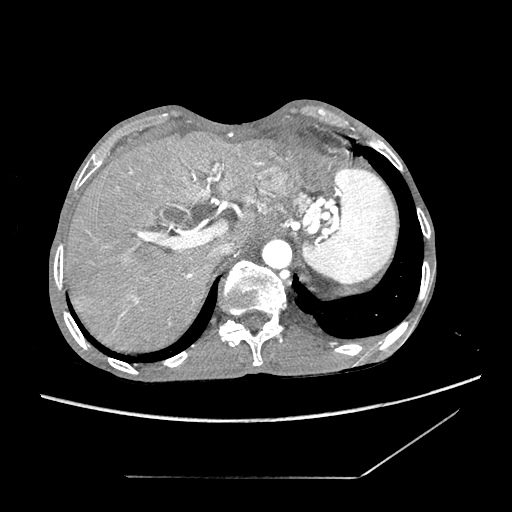 Closed-loop obstruction due to peritoneal seeding mimicking internal hernia after total gastrectomy (Radiopaedia 81897-95864 A 13).jpg