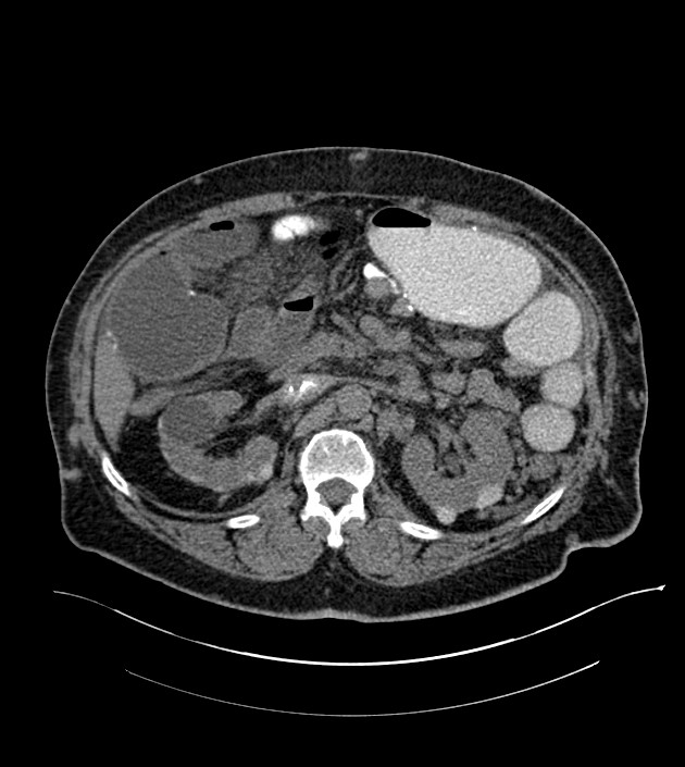 Closed-loop small bowel obstruction-internal hernia (Radiopaedia 78439-91096 Axial non-contrast 59).jpg