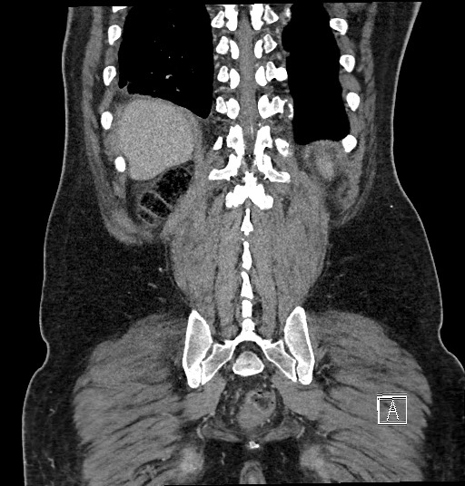 Closed loop obstruction - internal hernia into nephrectomy bed (Radiopaedia 59867-67320 B 119).jpg