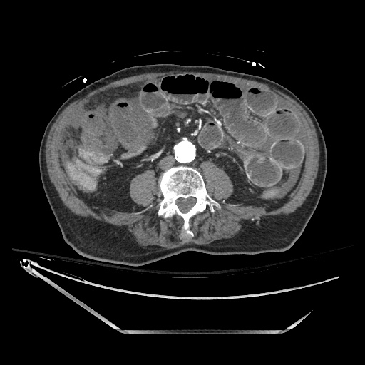 File:Closed loop obstruction due to adhesive band, resulting in small bowel ischemia and resection (Radiopaedia 83835-99023 Axial 215).jpg