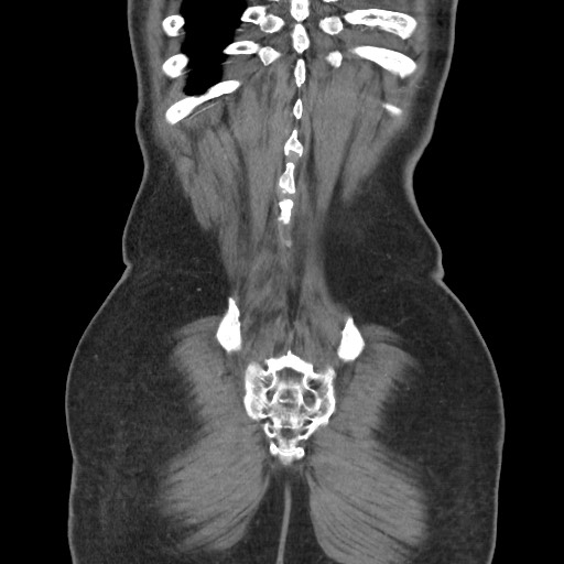 File:Closed loop obstruction due to adhesive band, resulting in small bowel ischemia and resection (Radiopaedia 83835-99023 C 112).jpg