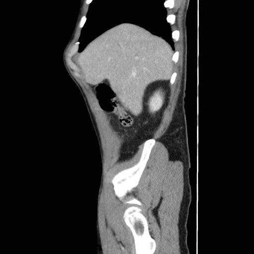 Closed loop small bowel obstruction (Radiopaedia 59227-66554 C 12).jpg