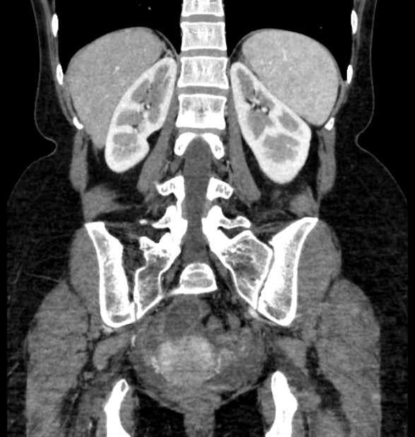 Closed loop small bowel obstruction (Radiopaedia 71211-81508 B 93).jpg