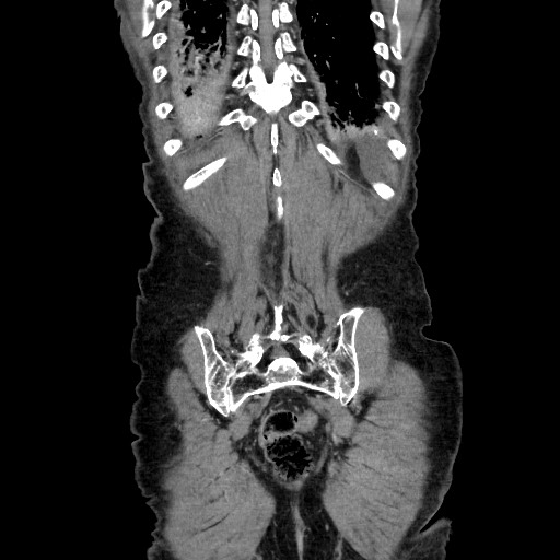 Closed loop small bowel obstruction - adhesive disease and hemorrhagic ischemia (Radiopaedia 86831-102990 B 111).jpg