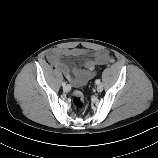 File:Closed loop small bowel obstruction - internal hernia (Radiopaedia 57806-64778 B 101).jpg
