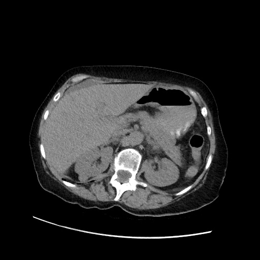 Closed loop small bowel obstruction due to adhesive band, with intramural hemorrhage and ischemia (Radiopaedia 83831-99017 Axial non-contrast 52).jpg