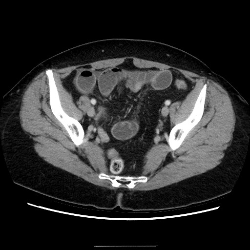 Closed loop small bowel obstruction due to adhesive bands - early and late images (Radiopaedia 83830-99015 A 136).jpg