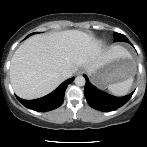 Closed loop small bowel obstruction due to trans-omental herniation (Radiopaedia 35593-37109 A 18).jpg