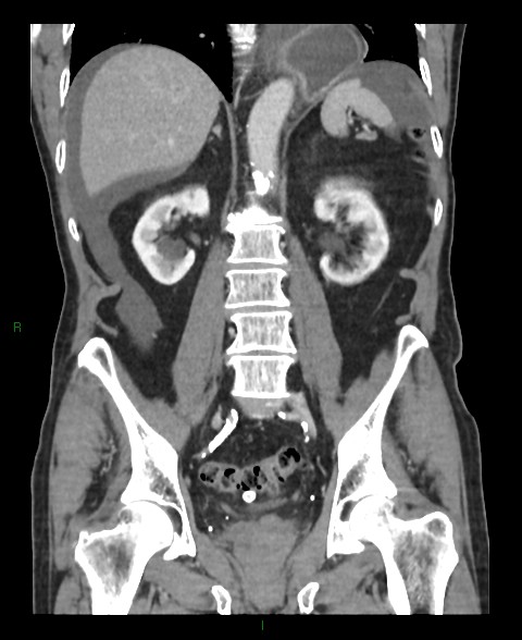 Closed loop small bowel obstruction with ischemia (Radiopaedia 84180-99456 B 25).jpg