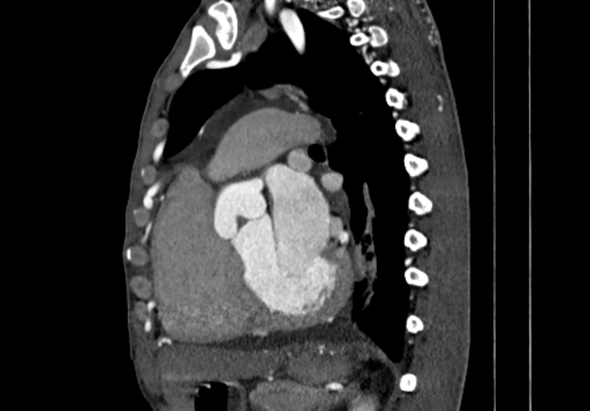 Coarctation of aorta with aortic valve stenosis (Radiopaedia 70463-80574 B 93).jpg