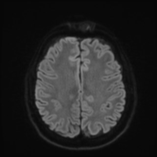 Cochlear incomplete partition type III associated with hypothalamic hamartoma (Radiopaedia 88756-105498 Axial DWI 68).jpg
