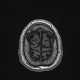 Cochlear incomplete partition type III associated with hypothalamic hamartoma (Radiopaedia 88756-105498 Axial T1 175).jpg