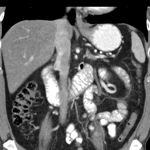 File:Collateral circulation following left renal vein thrombosis (Radiopaedia 17319-17013 renal cortical phase 16).jpg