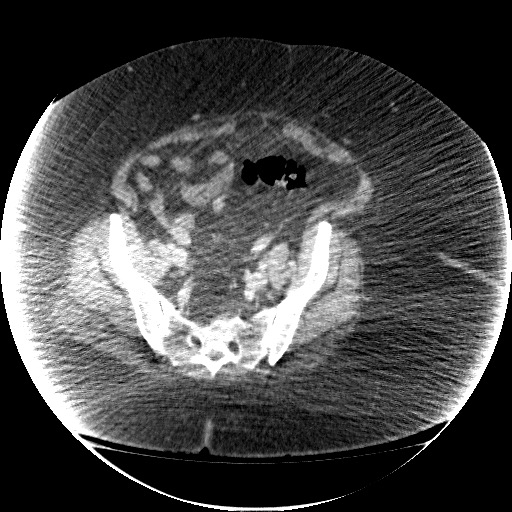 Collection due to leak after sleeve gastrectomy (Radiopaedia 55504-61972 A 64).jpg