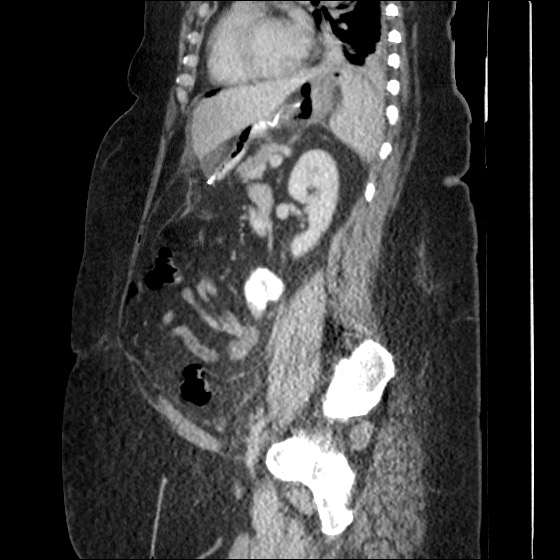 File:Collection due to leak after sleeve gastrectomy (Radiopaedia 55504-61972 C 29).jpg