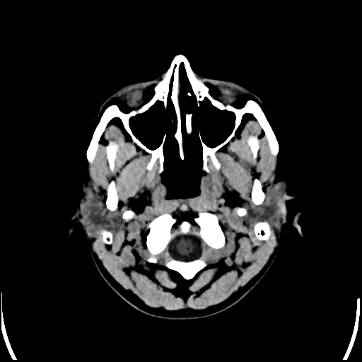Colloid cyst (Radiopaedia 78104-90633 Axial non-contrast 7).jpg