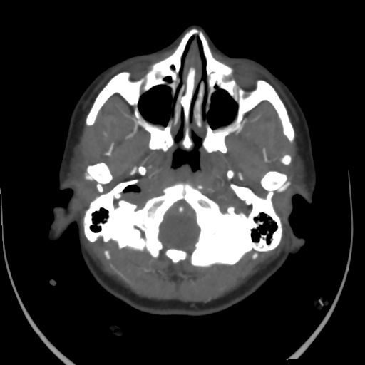 File:Colloid cyst (resulting in death) (Radiopaedia 33423-34499 A 7).png