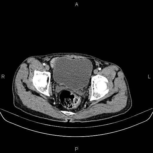 Colon adenocarcinoma - hepatic flexure (Radiopaedia 85635-101395 A 88).jpg