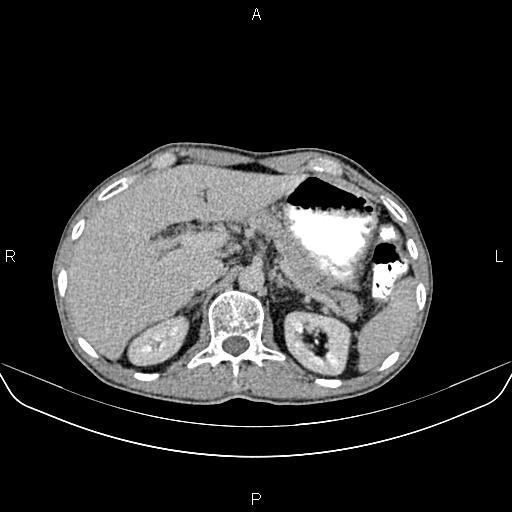File:Colon adenocarcinoma - hepatic flexure (Radiopaedia 85635-101395 Axial C+ delayed 24).jpg