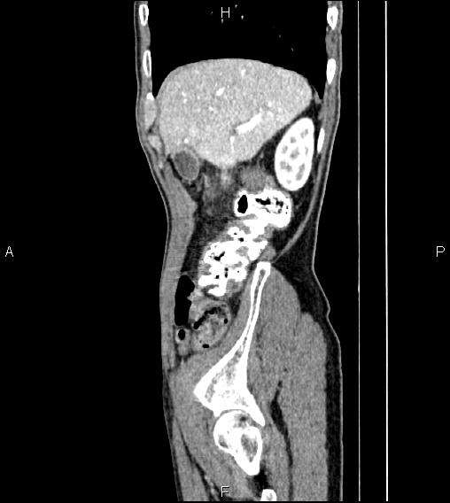 Colon adenocarcinoma - hepatic flexure (Radiopaedia 85635-101395 D 15).jpg