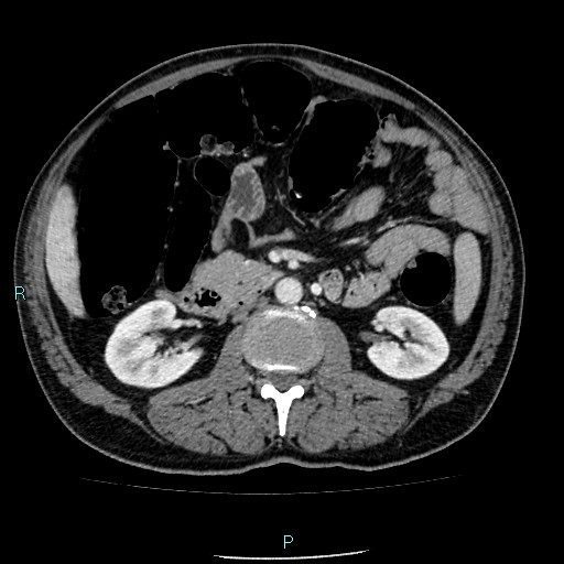 Colon adenocarcinoma with calcific liver metastasis (Radiopaedia 55745-62300 B 19).jpg
