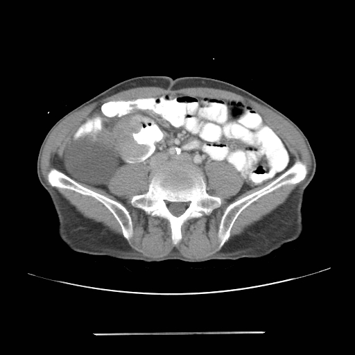 File:Colon cancer with calcified liver metastasis (Radiopaedia 74423-85307 A 48).jpg