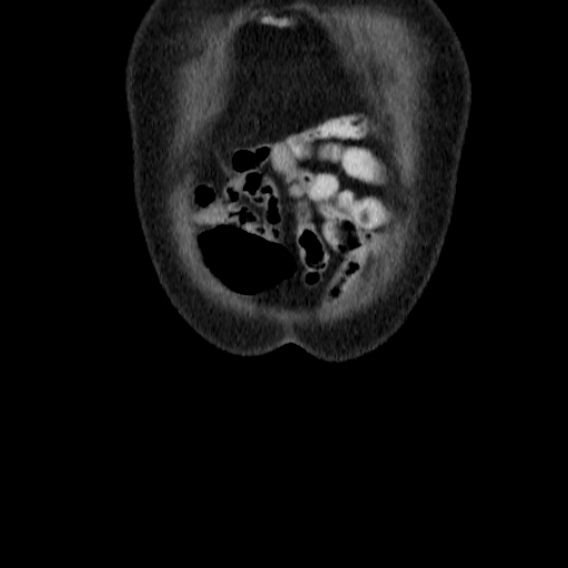 File:Colon cancer with duodenal invasion (Radiopaedia 16278-15958 B 3).jpg