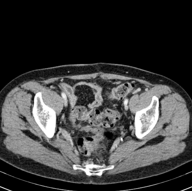 Colon carcinoma with hepatic metastases (Radiopaedia 29477-29961 A 99).jpg