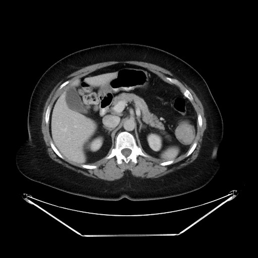 File:Colonic intussusception due to adenocarcinoma (Radiopaedia 86828-102987 A 48).jpg