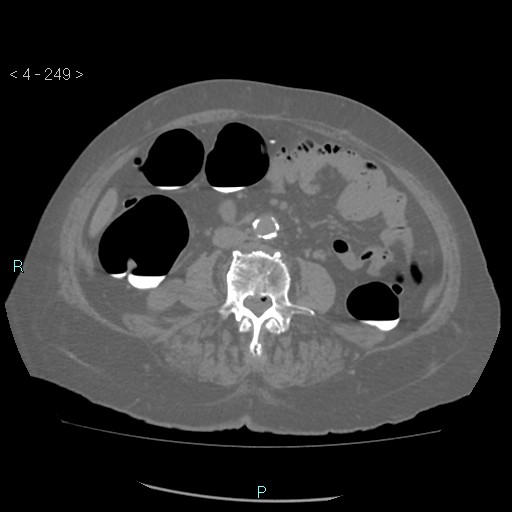 Colonic lipomas (Radiopaedia 49137-54244 Axial bone window 111).jpg