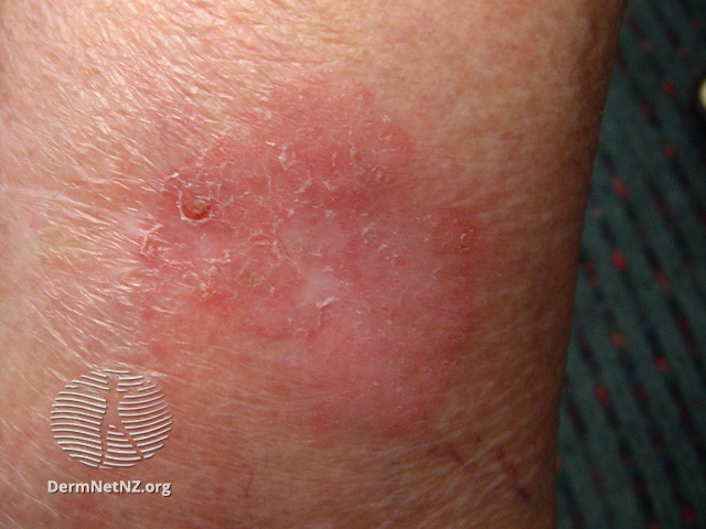 File:Intraepidermal carcinoma (DermNet NZ lesions-scc-in-situ-2946).jpg
