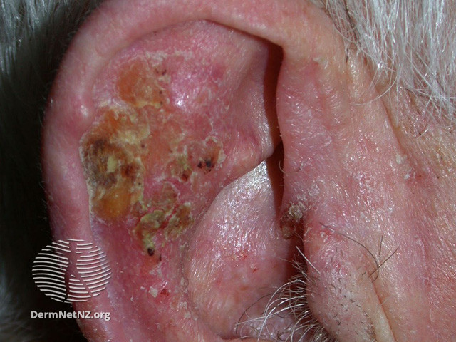 Intraepidermal carcinoma (DermNet NZ lesions-scc-in-situ-2958).jpg