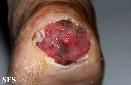 File:Melanoma (Dermatology Atlas 81).jpg