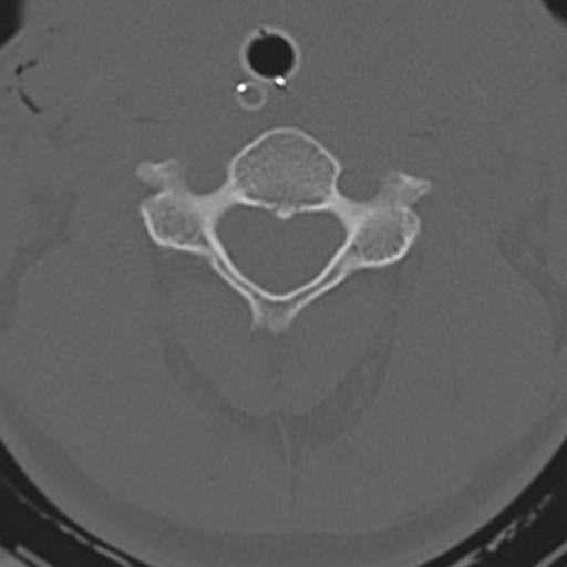 File:Multitrauma with diffuse axonal injury, temporal bone fractures and traumatic caroticocavernous fistula (Radiopaedia 37242-39035 Axial 191).png