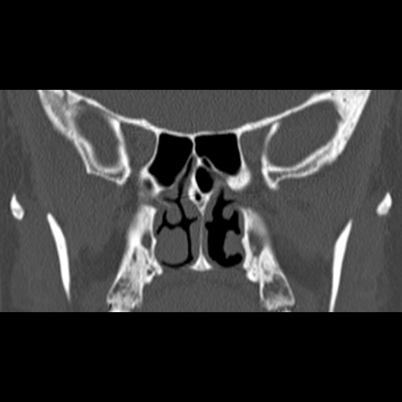 Nasal septal perforation (Radiopaedia 25030-25289 Coronal bone window 48).jpg