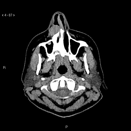 Nasolabial cyst (Radiopaedia 75125-86194 Axial non-contrast 49).jpg
