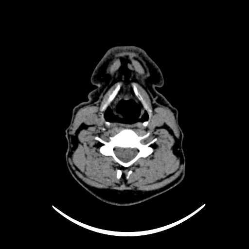 File:Nasopharyngeal carcinoma - infiltrating the clivus (Radiopaedia 62583-70875 Axial non-contrast 48).jpg
