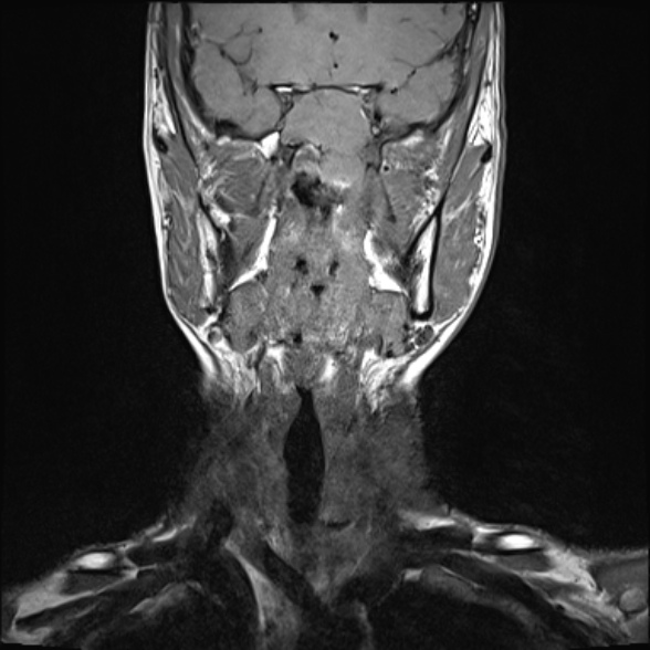 Nasopharyngeal carcinoma with skull base invasion (Radiopaedia 53415-59485 Coronal T1 24).jpg