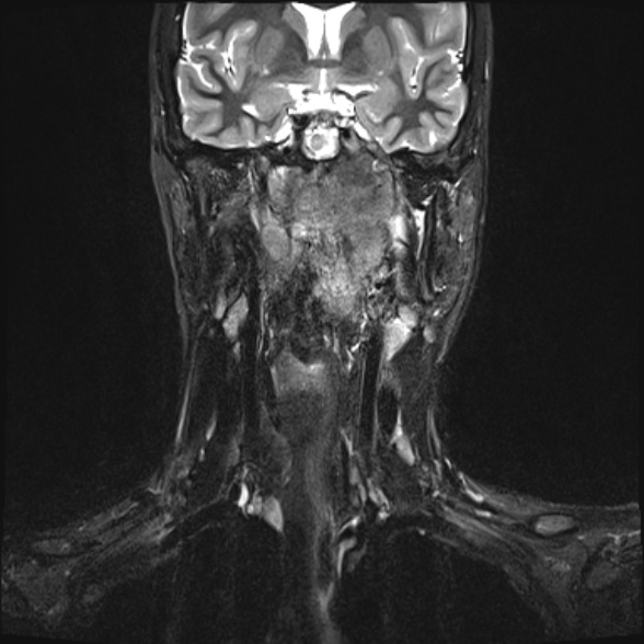 Nasopharyngeal carcinoma with skull base invasion (Radiopaedia 53415-59485 Coronal T2 fat sat 18).jpg