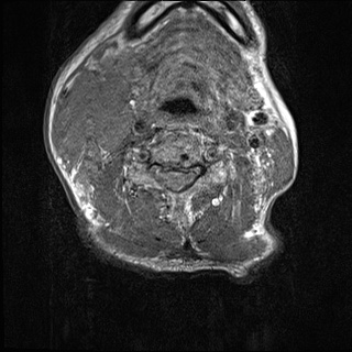 File:Nasopharyngeal carcinoma with skull base invasion (Radiopaedia 59258-66600 Axial T1 2).jpg