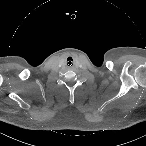 Neck CT angiogram (intraosseous vascular access) (Radiopaedia 55481-61945 B 138).jpg