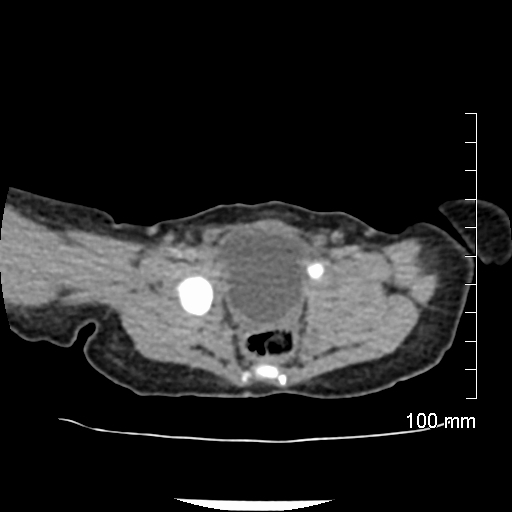 File:Neonatal neuroblastoma (Radiopaedia 56651-63438 Axial non-contrast 74).jpg