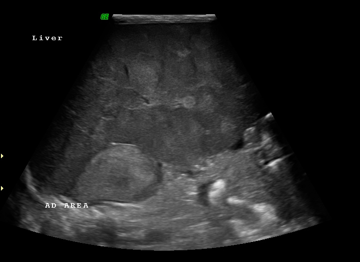 File:Neonatal neuroblastoma (Radiopaedia 9564-10221 A 9).jpg
